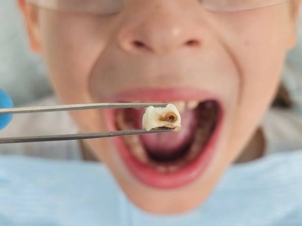 Best Emergency Dental Care for Abscessed Tooth in Sparta, TN