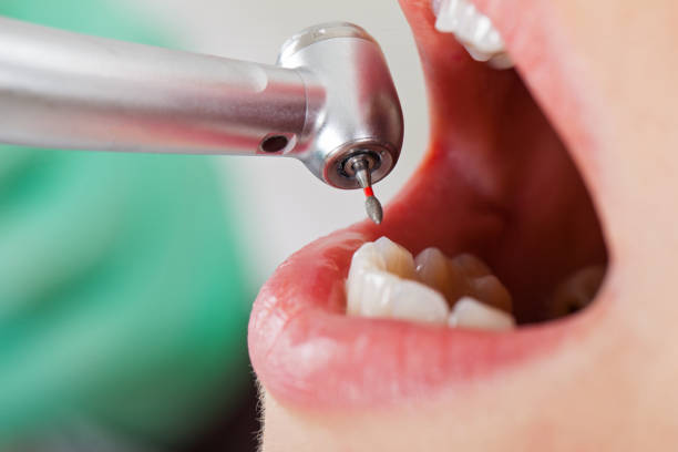 Best Emergency Dental Extractions in Sparta, TN